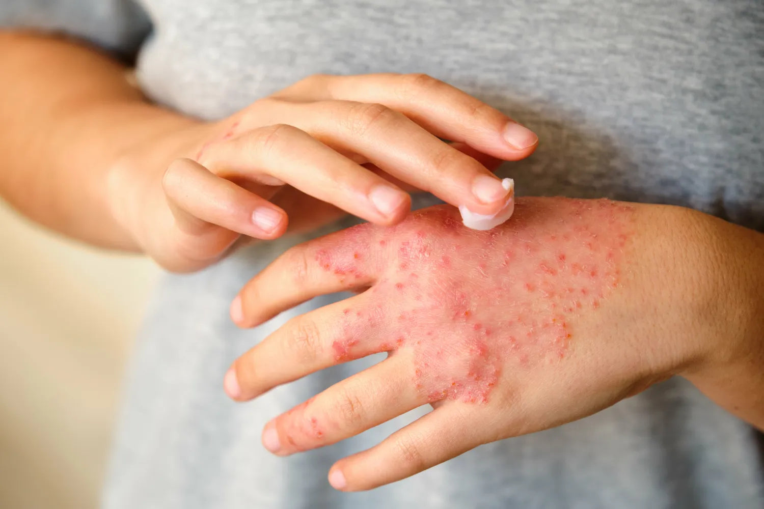 Close-up of hands applying cream to a red, inflamed eczema rash on the back of a hand against a gray shirt background